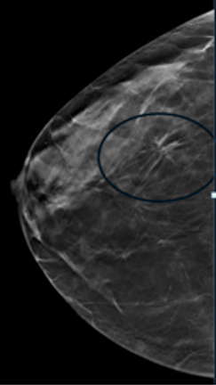 A Look At Mammography: 2D Vs 3D - Simply Well