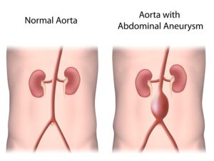 normal aorta versus aorta with bulging aneurysm