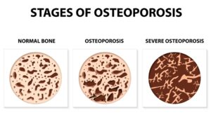 bone density at the three stages of osteoporosis